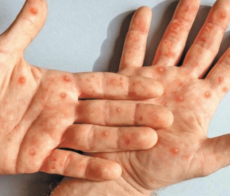 Registra SSA alza de 21% en casos de viruela símica