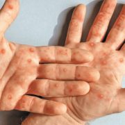 Viruela del mono puede ser mortal para quienes tienen VIH o un sistema inmune débil: estudio